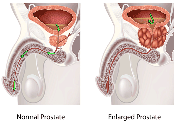 What does an inflamed prostate indicate?